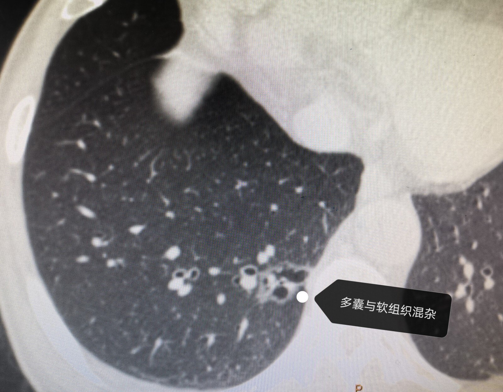 小心肺叶上的这个"泡":囊腔空泡样肺癌_肺癌_介绍_检查 - 好大夫在线