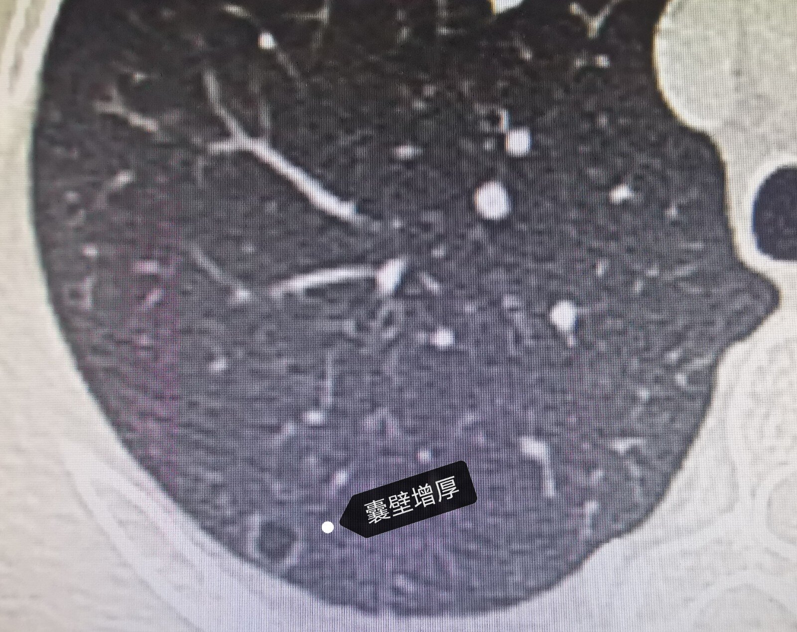 小心肺叶上的这个"泡":囊腔空泡样肺癌_肺癌_介绍_检查 - 好大夫在线