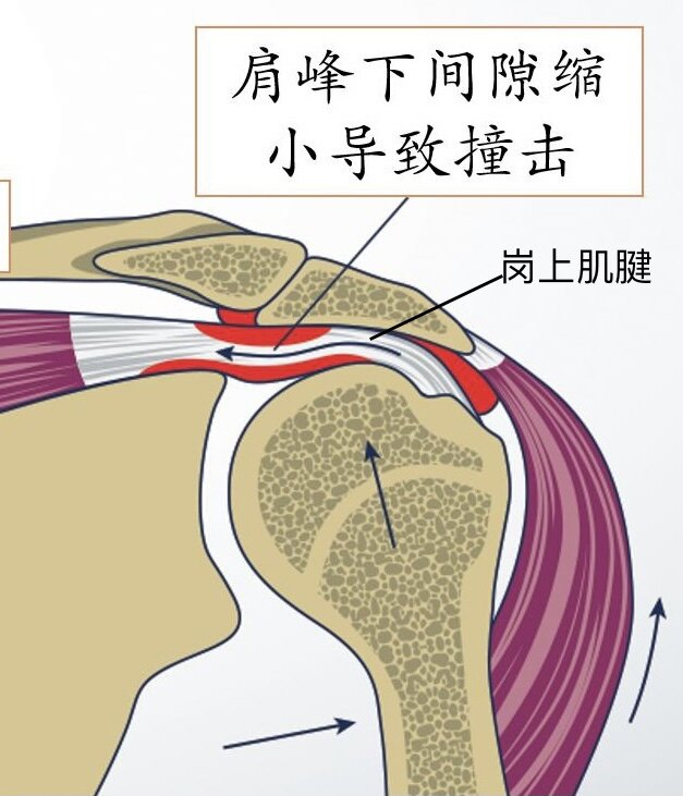 肩袖损伤位置图图片