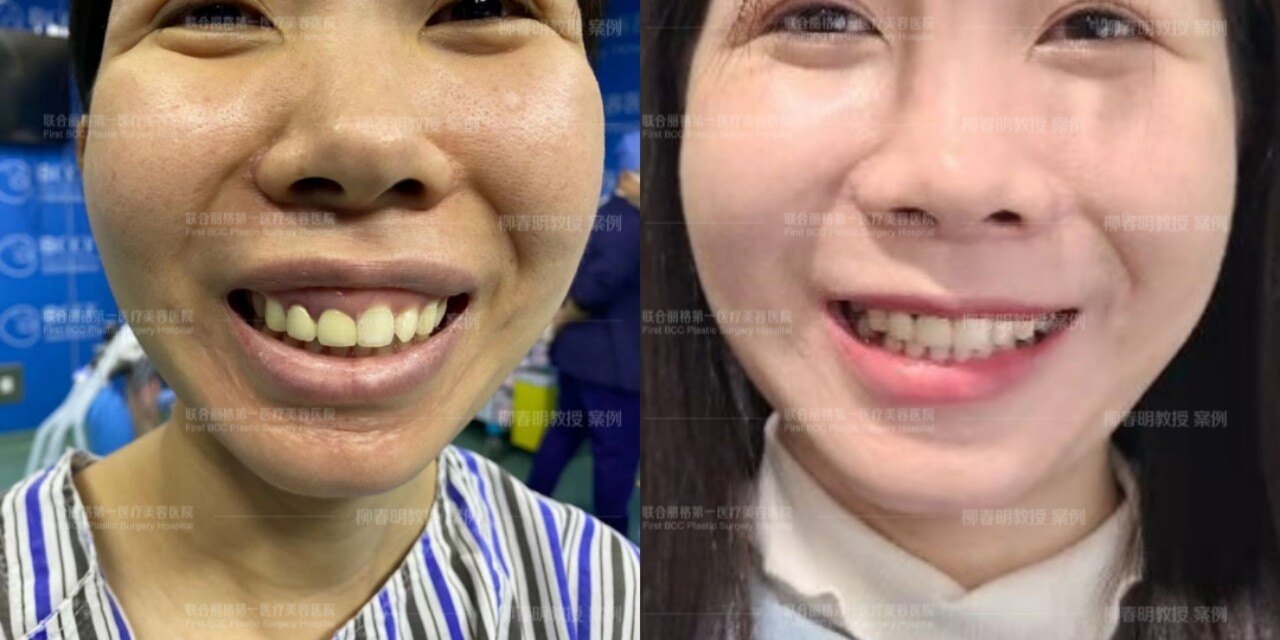 正颌手术这个让人尴尬的笑容露龈笑你有吗