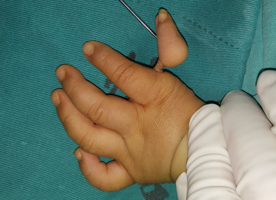 先天性拇指发育不良漂浮指手术效果怎么样?