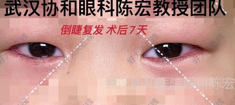 眼瞼內翻倒睫矯正