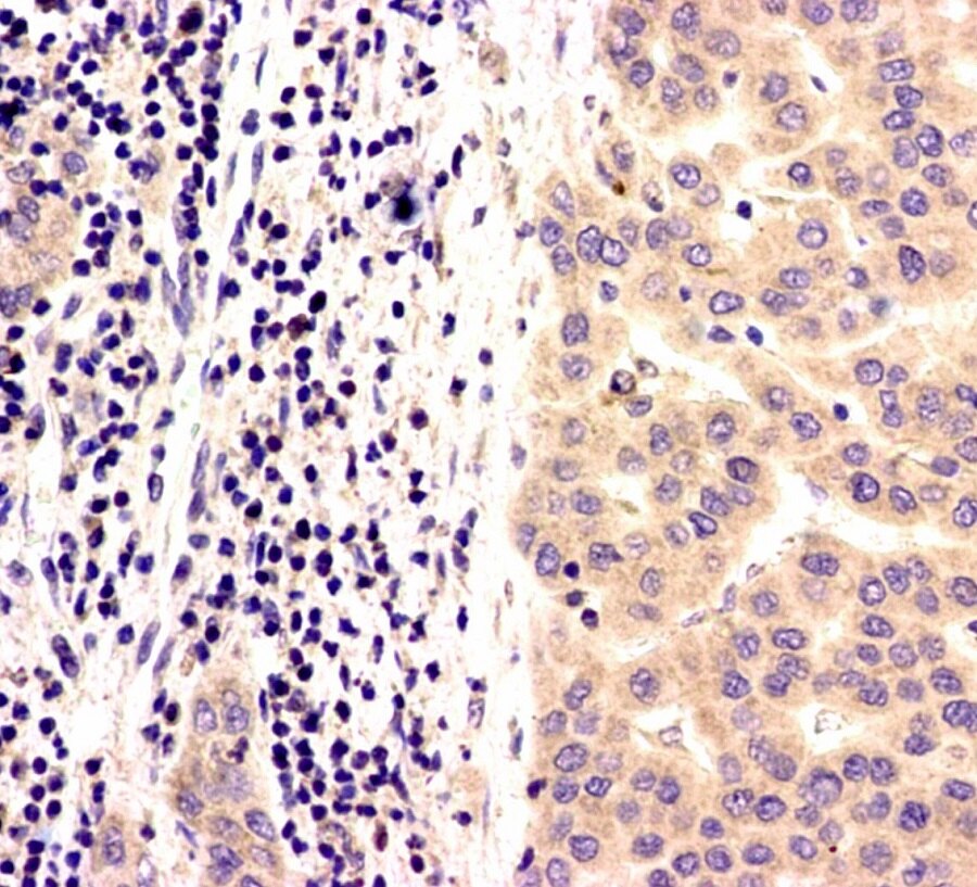 肿瘤类型诊断,依据病变形态就能做出明确病理诊断,不需要做免疫组化
