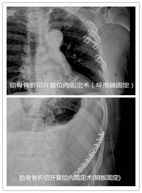 常用的肋骨骨折内固定材料简介 肋骨骨折 好大夫在线 常用的肋骨骨折内固定材料简介 肋骨骨折 好大夫在线