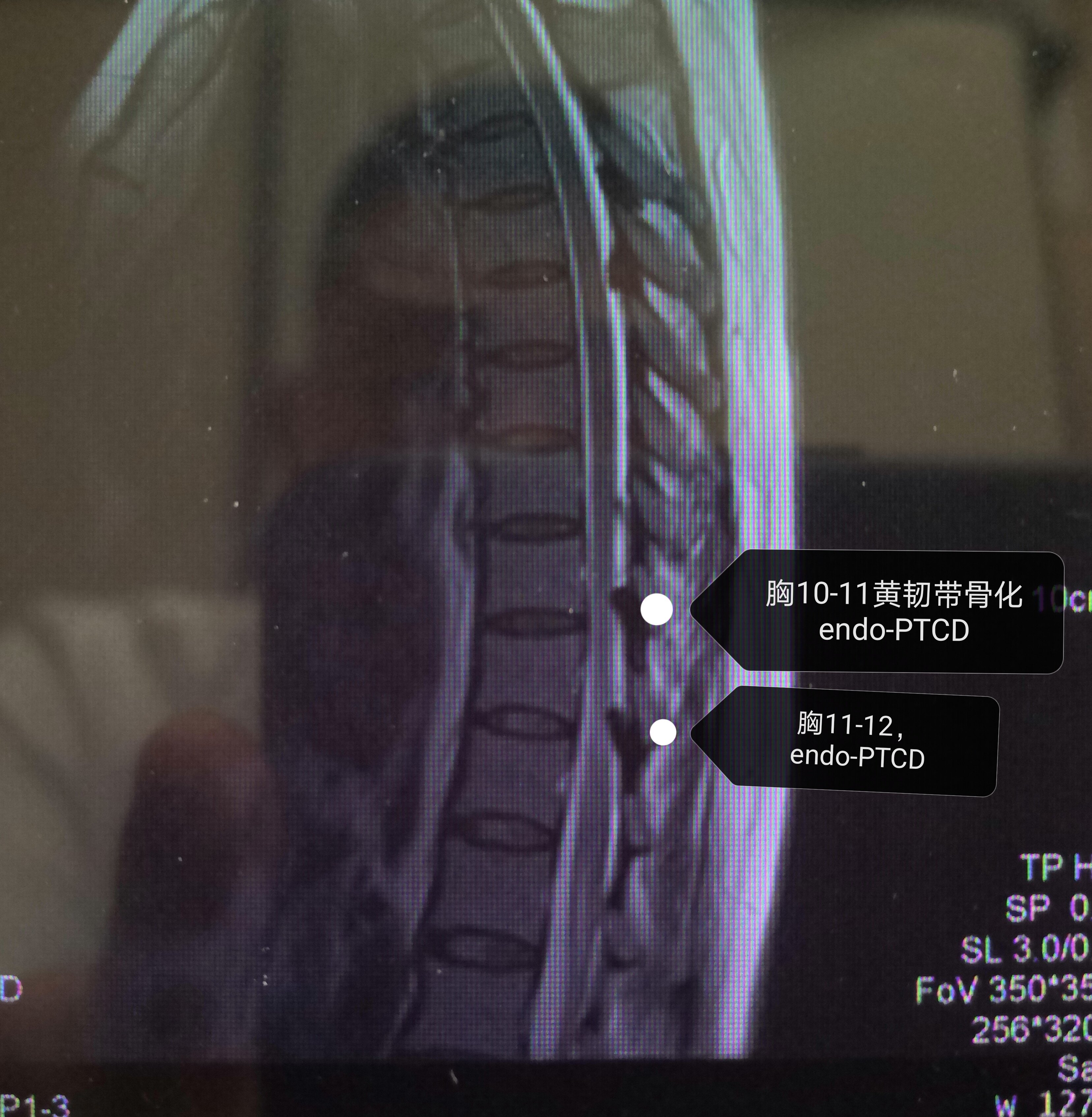 胸椎黄韧带骨化,胸椎管狭窄症,内镜微创椎管减压 - 好大夫在线