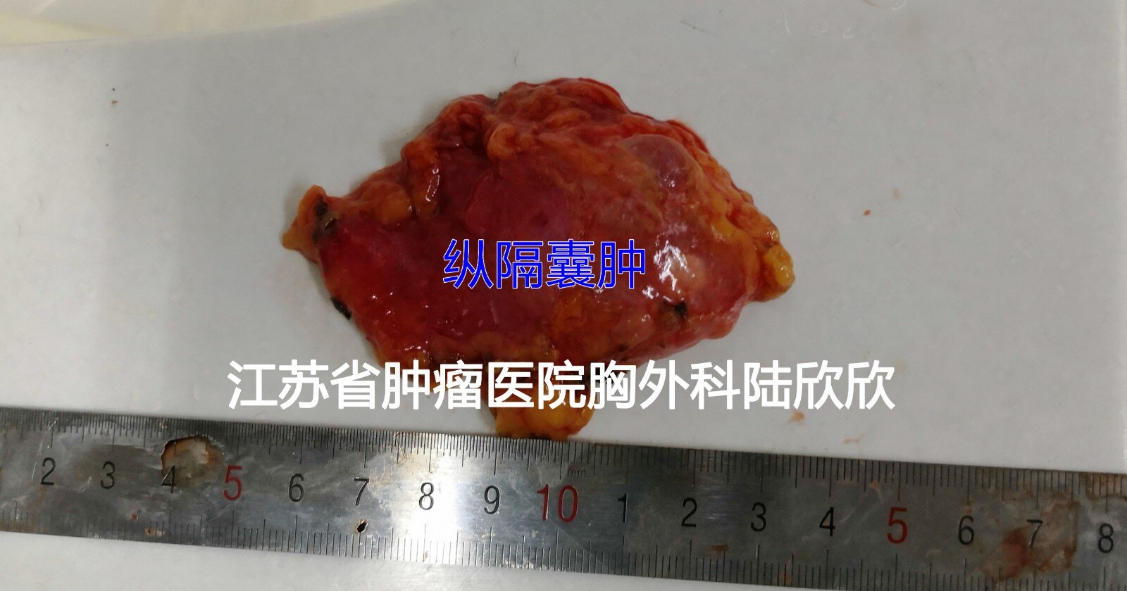 磨玻璃结节故事11:因为纵隔肿瘤住院,多发现4个肺磨玻璃结节 - 好大夫