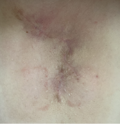 手术后刀口好了但里面还疼 zYYBAGXDfaGABftwAAKxkc8kUpA615.png?_ms_=300c