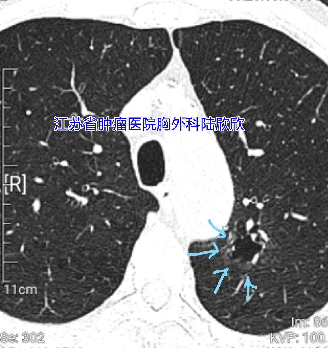 兩釐米以上的磨玻璃結節長什麼樣子圖解大型混合磨玻璃結節