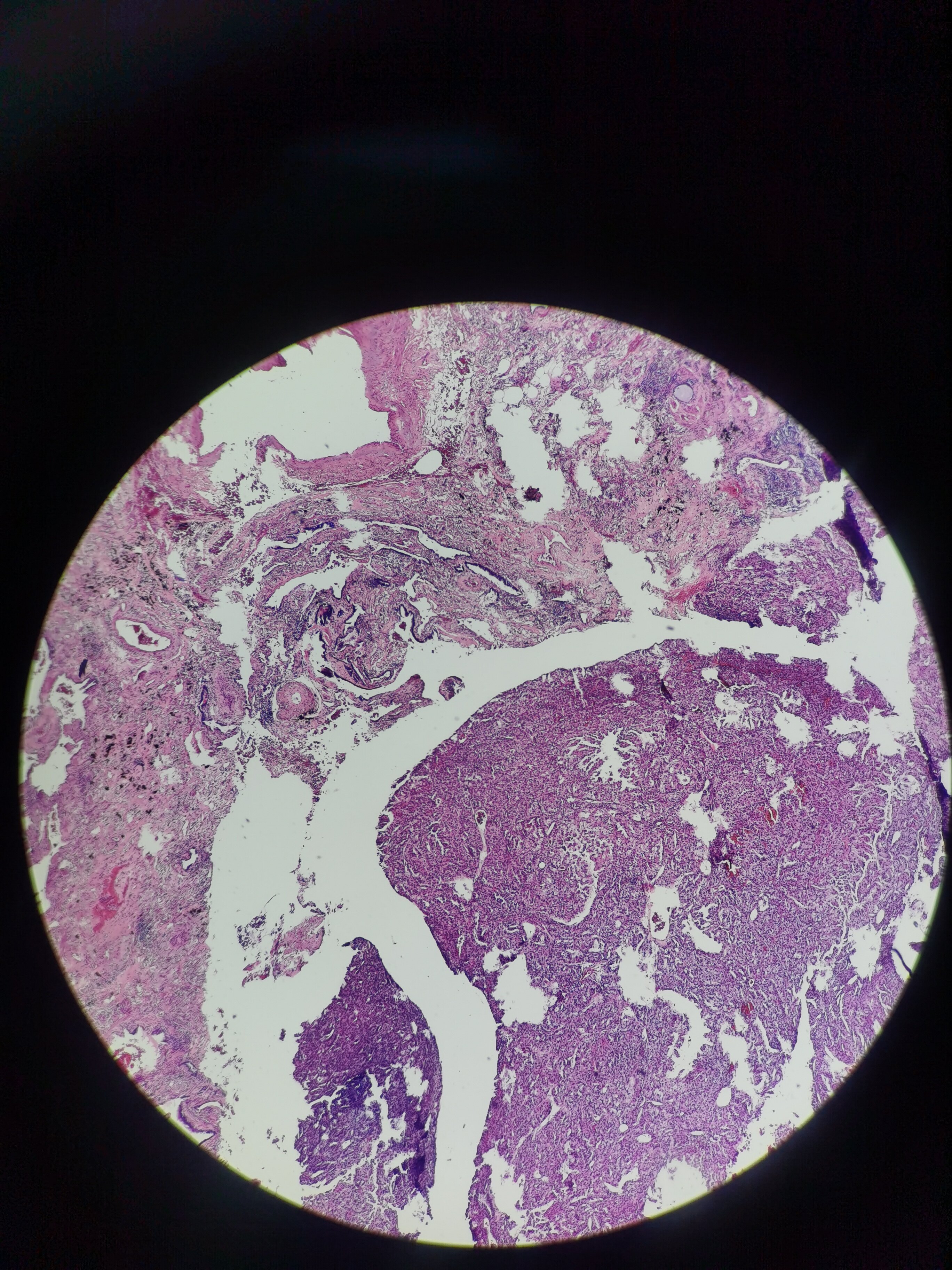 肠腺癌患者,1年前术前发现肺结节,肺内占位镜下多量坏死凝固性坏死3.