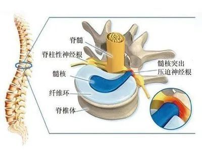 腰椎间盘突出症与腰椎管狭窄症的非手术治疗 腰椎管狭窄 腰椎管狭窄 好大夫在线