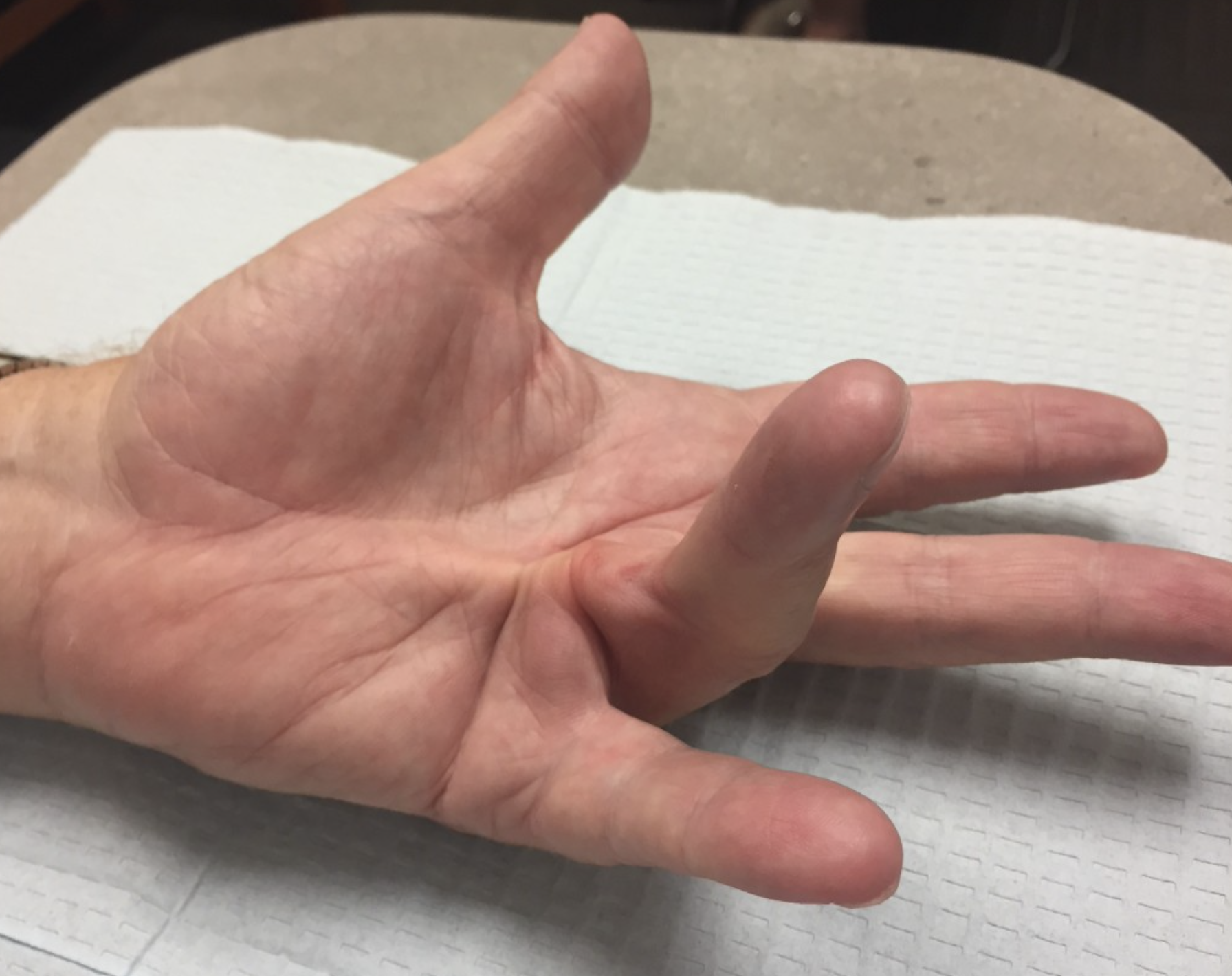 手掌筋膜炎图片