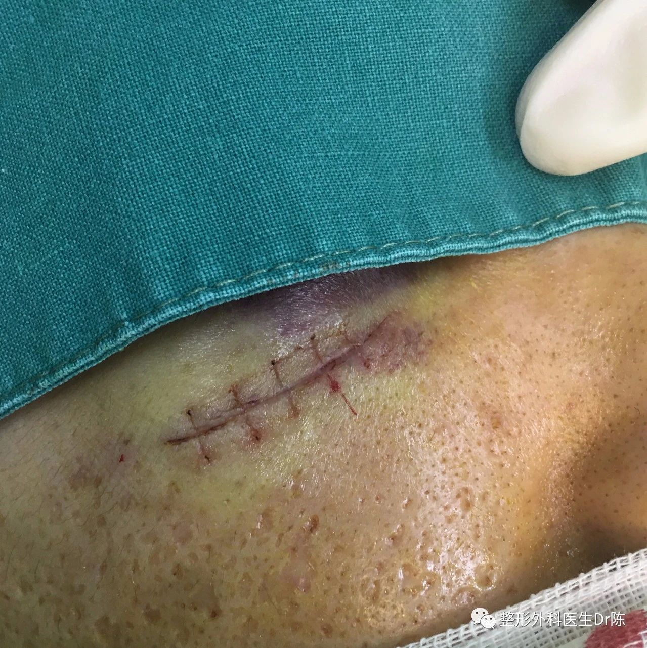 吃烧烤吵架被啤酒瓶干了的小兄弟……)本例患者的伤口,就急诊缝合来说