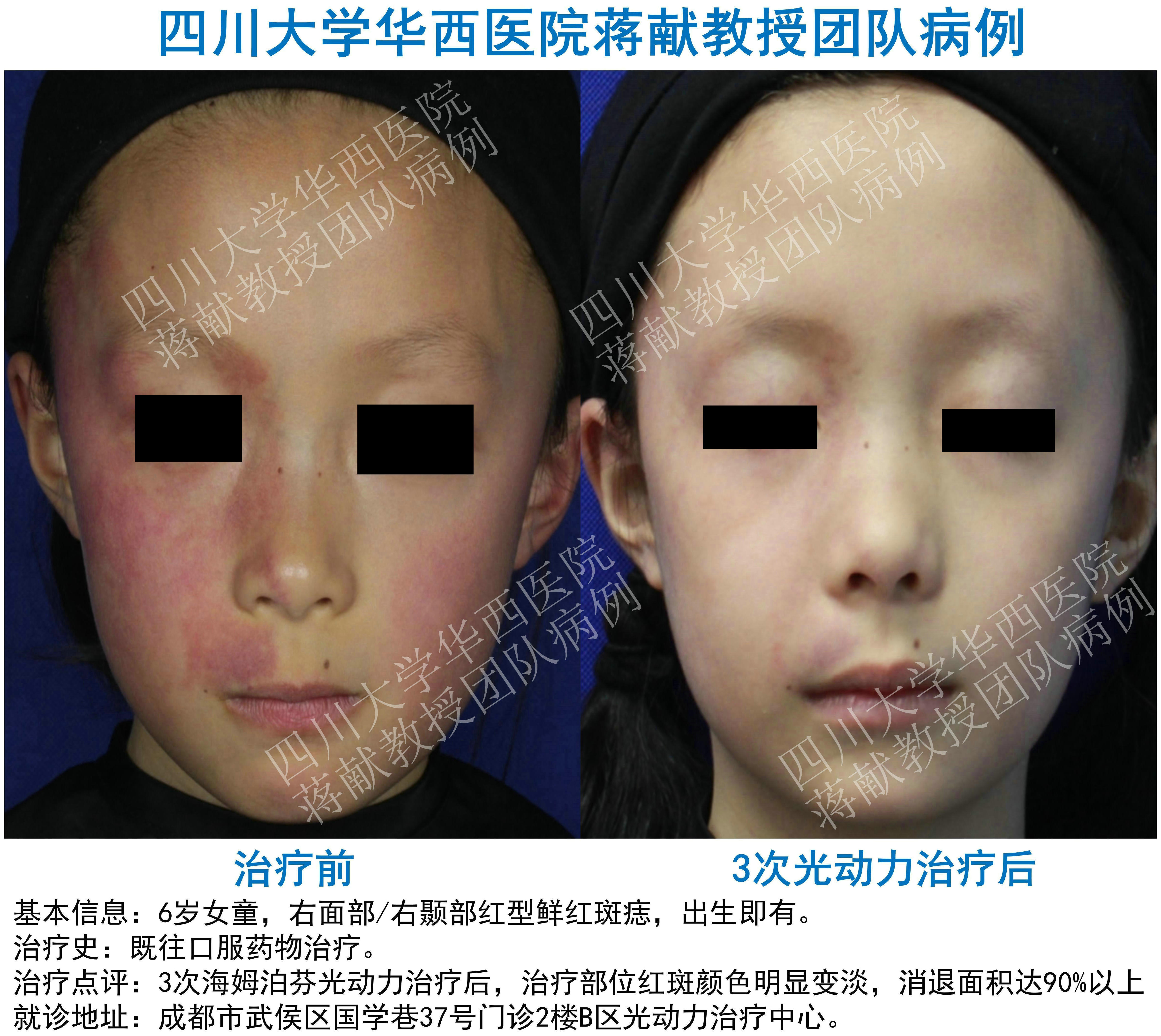 面部鲜红斑痣光动力治疗疗效分享高清对比图