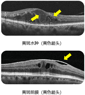 視力健康殺手——黃斑病變(1)_黃斑病_介紹_症狀表現 - 好大夫在線