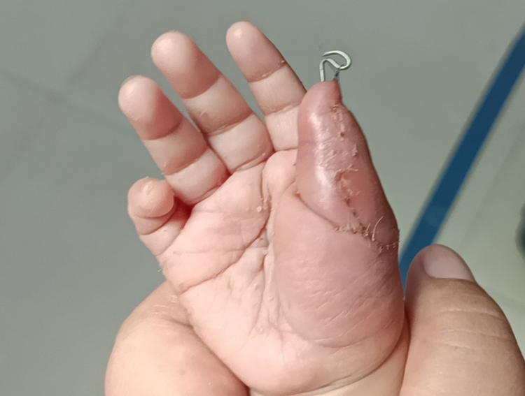 多指术后不到十天,恢复得不错 - 好大夫在线