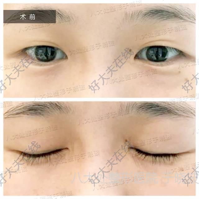 评估分析:从术前的照片可以看得出来,明显的皮肤松弛,重睑线条不完整