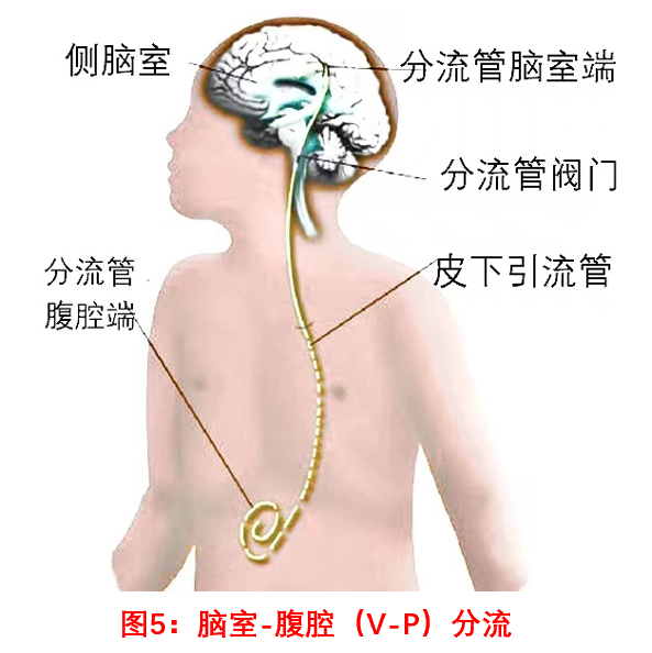 脑积水症状图片