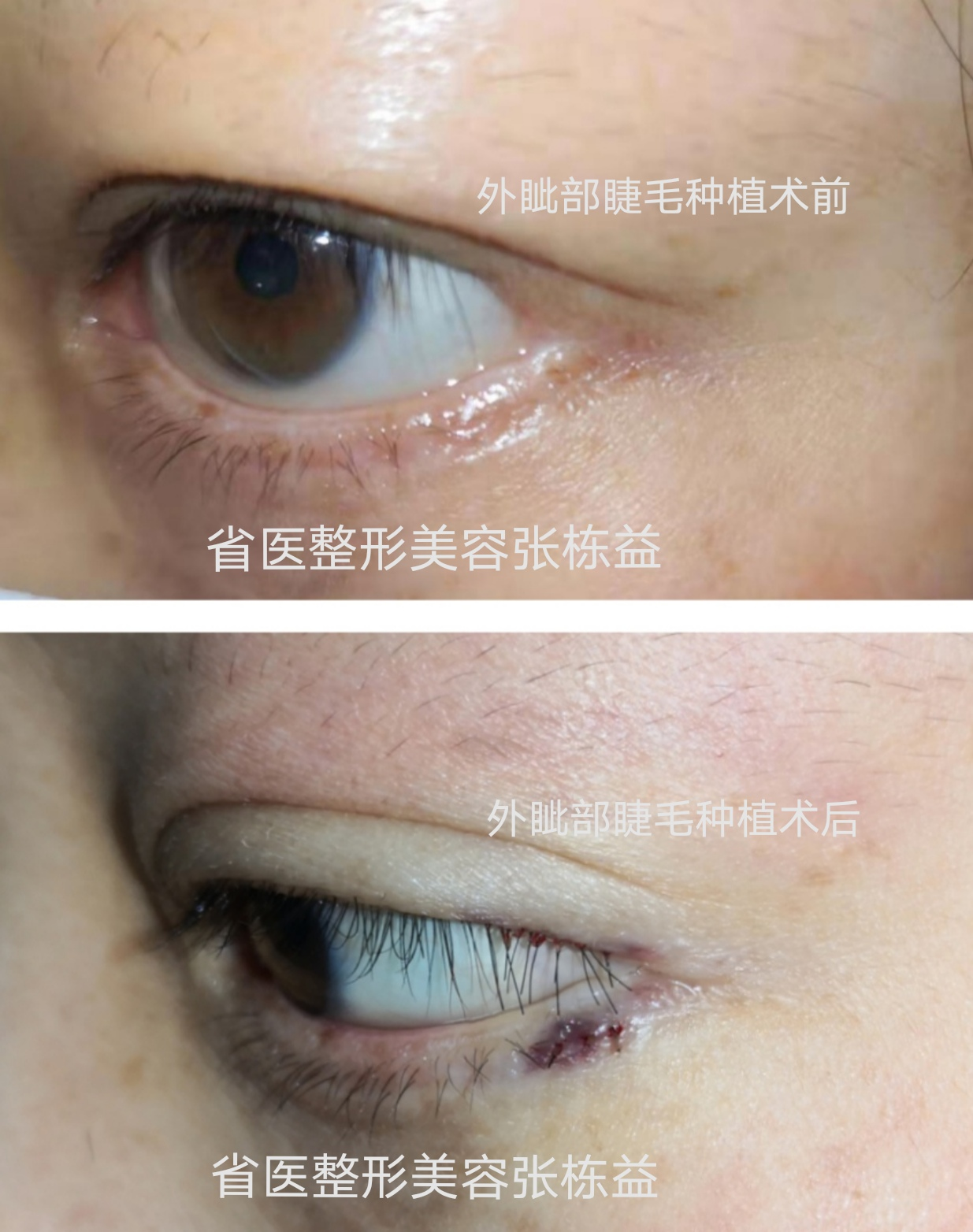 案例7 外眦瘢痕区睫毛缺失   fue毛发移植技术睫毛种植术前与术后对比