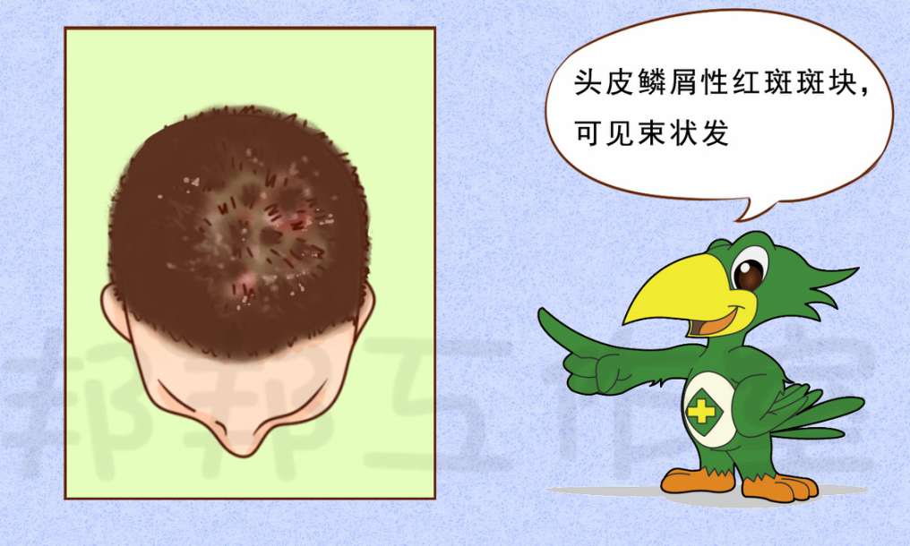 发生于头皮部位的银屑病,最常与头皮脂溢性皮炎,头癣相混淆.