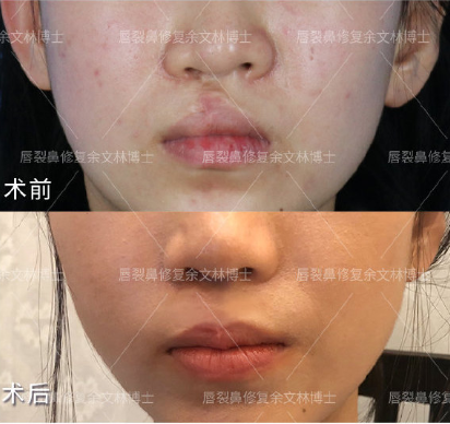 唇腭裂_唇腭裂治疗方式 - 好大夫在线