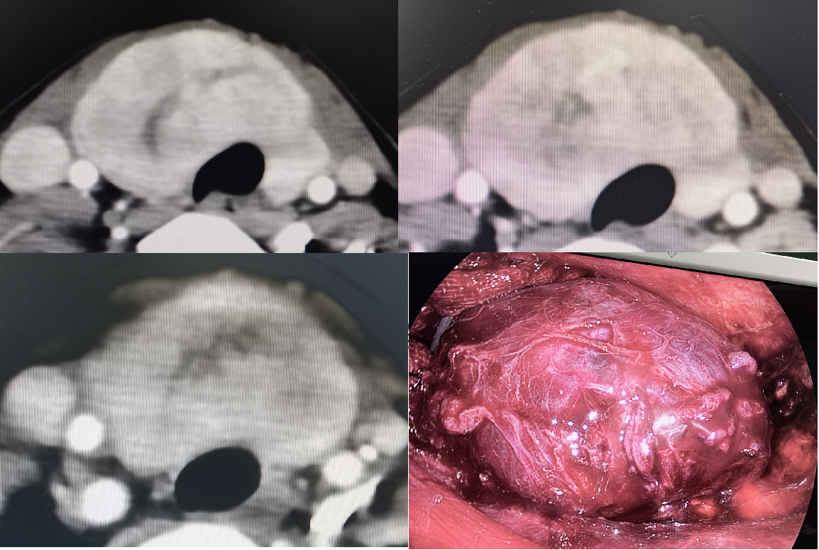 腔鏡下巨大甲狀腺結節切除