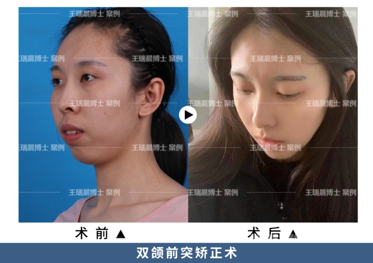 【正颌手术案例分享】双颌前突矫正术+颏成型术前和术后15天对比(照片为案例,我院拥有肖像使用权) - 好大夫在线