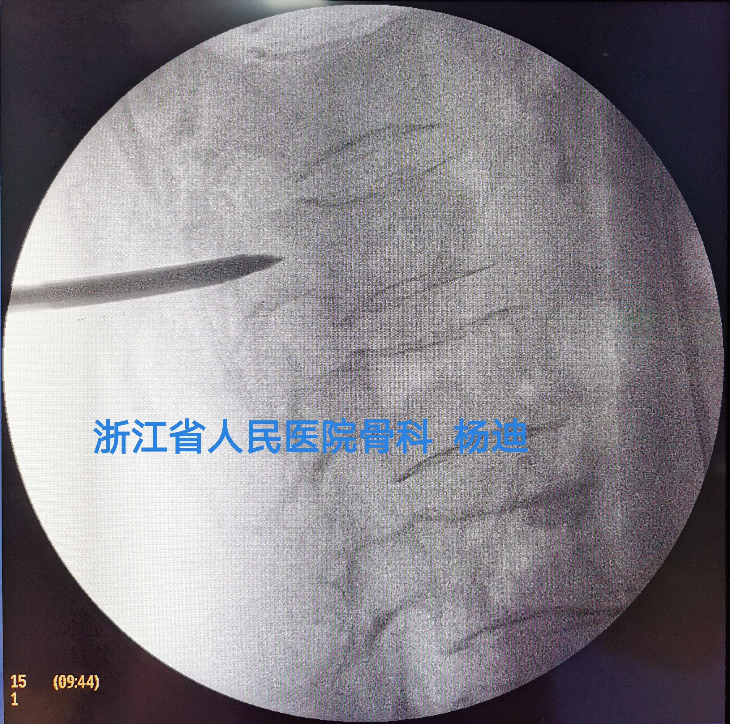 微創骨水泥pkp治療老年脊柱骨質疏鬆性骨折