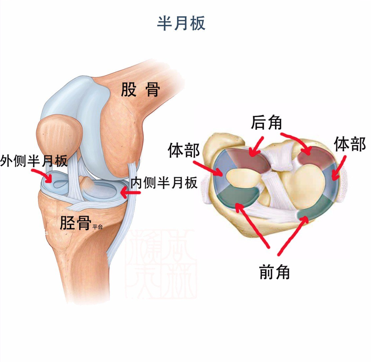 什么是 盘状半月板 膝关节半月板损伤