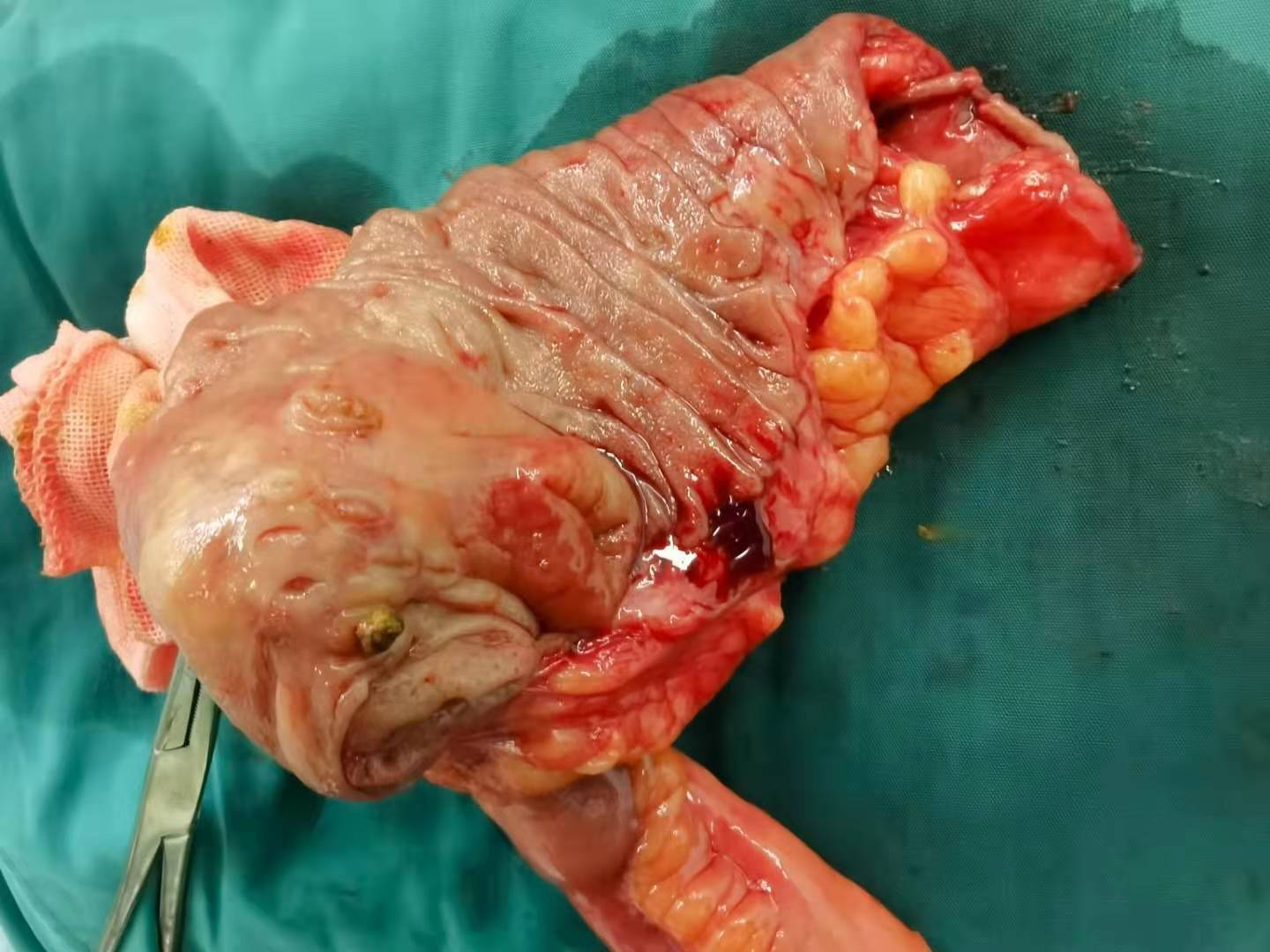 间歇性右下腹疼痛6年结肠憩室炎