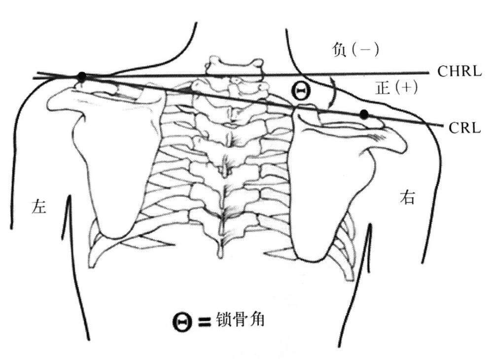 脊柱侧弯lenke分型图谱图片