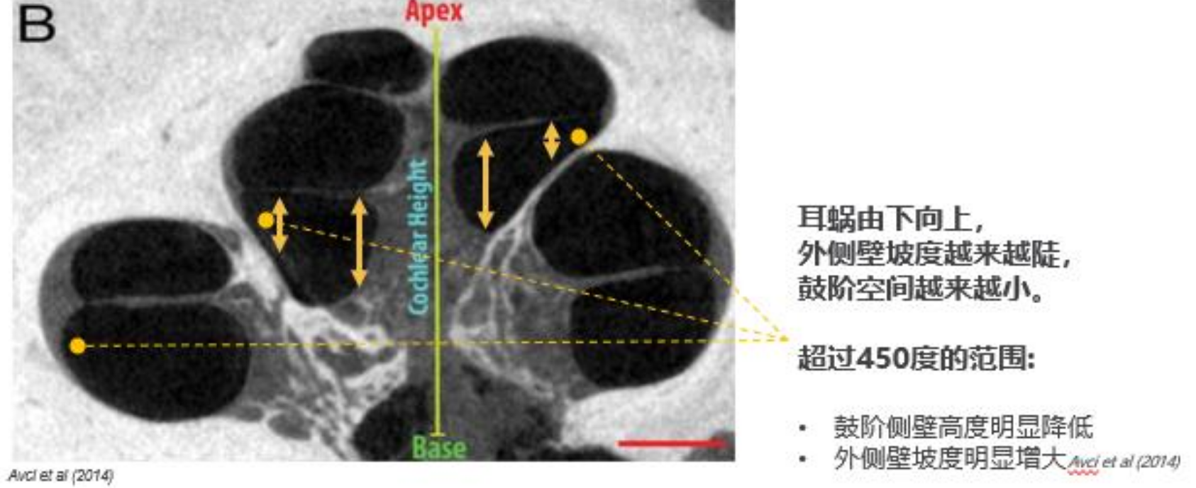 微創手術在人工耳蝸植入中的應用_人工耳蝸_人工耳蝸治療介紹 - 好