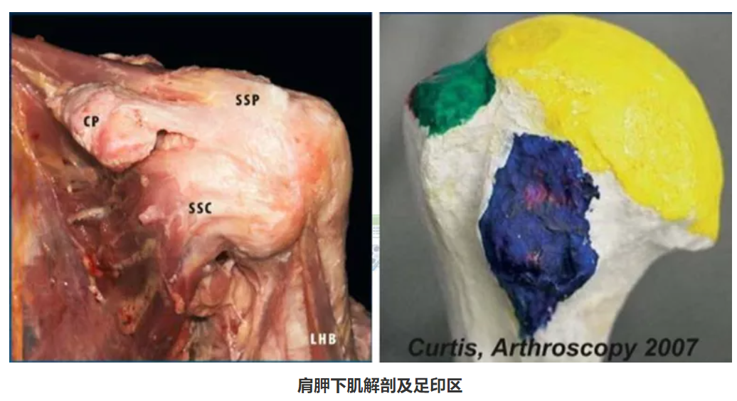 肩胛下肌是肩袖四组肌腱中最强大的一组,占肩袖力量的约50%,是肩关节