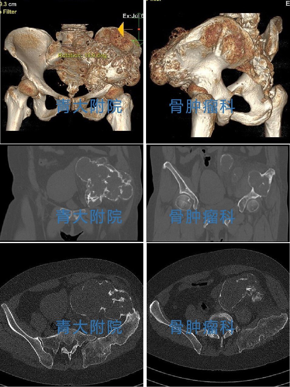 典型病例3d打印半骨盆假體治療骨盆巨大惡性腫瘤