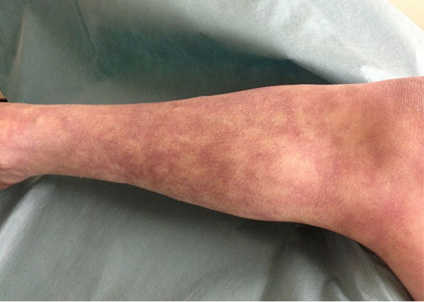 新冠肺炎的相关皮肤表现