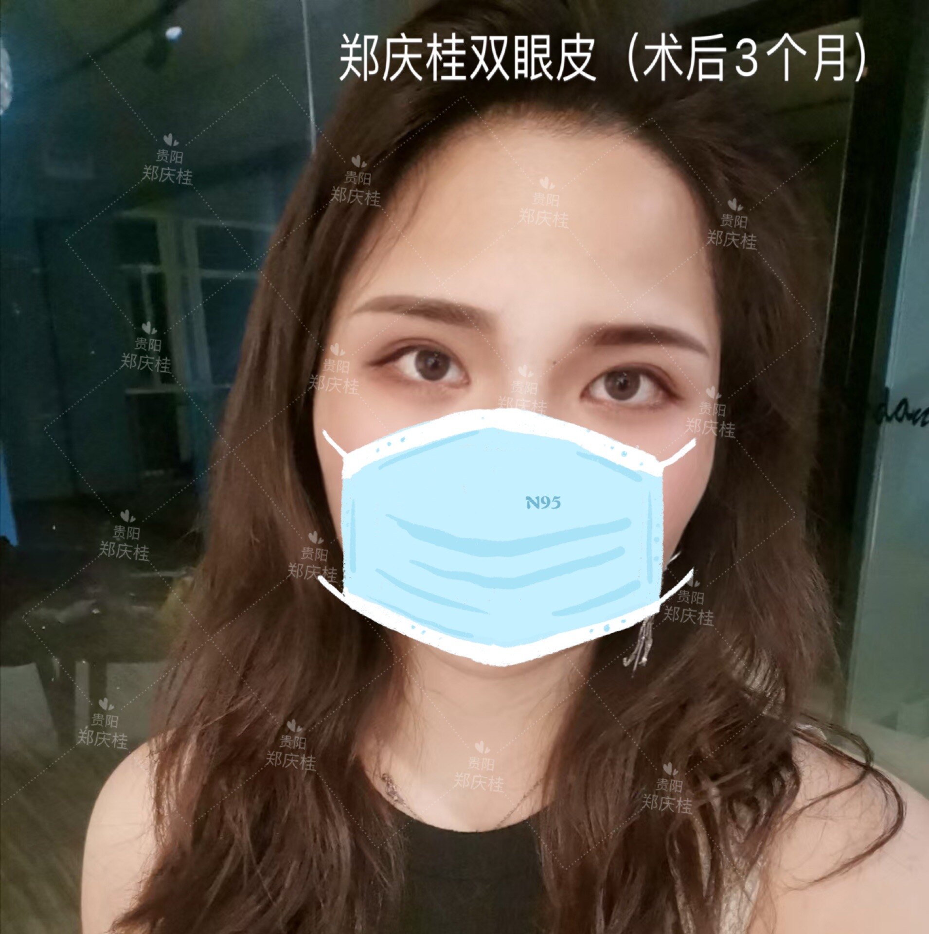 妈生眼自然开扇双眼皮,贵州省贵阳市郑庆桂副主任医师