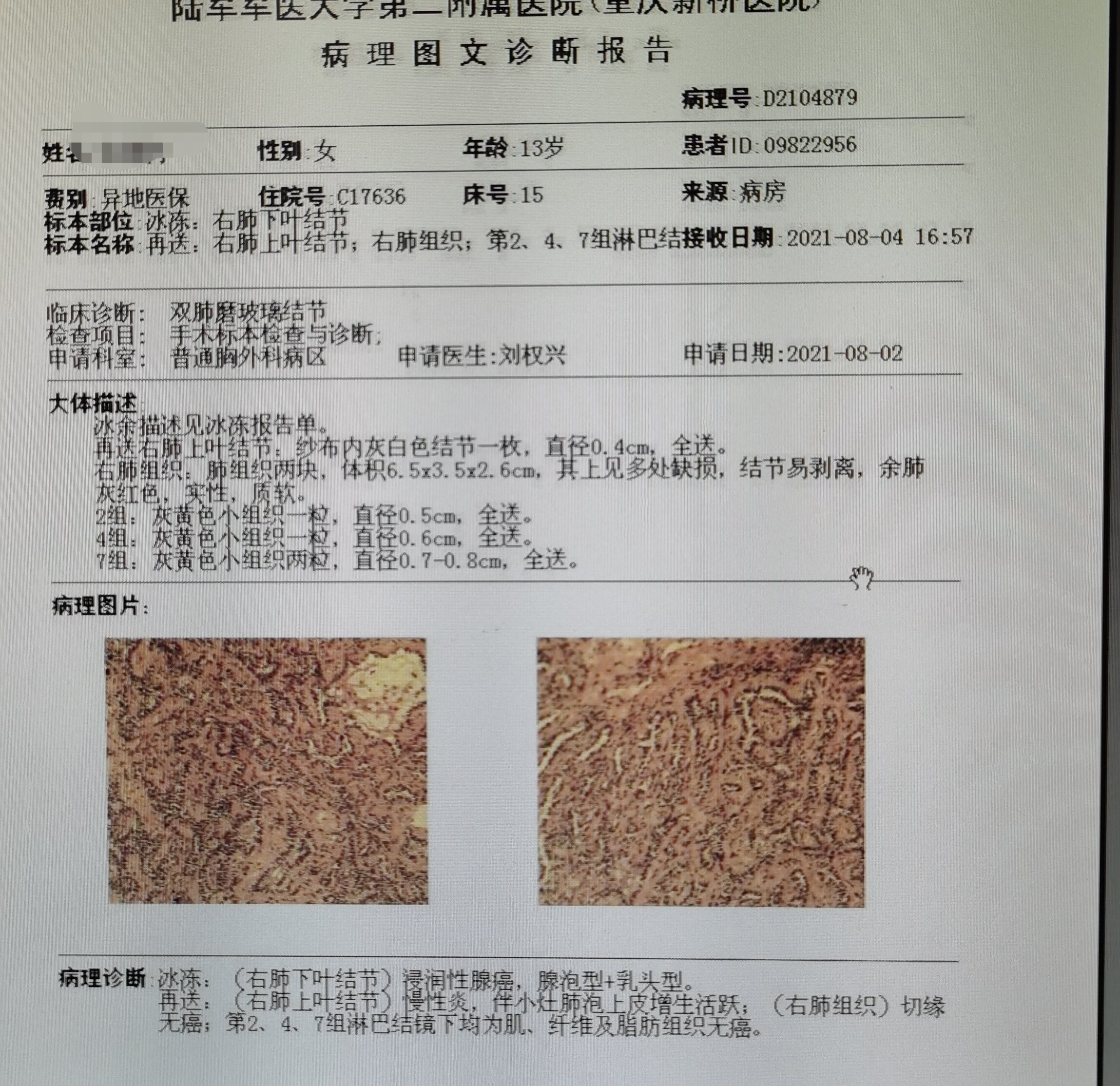 13和18岁磨玻璃结节肺癌患者同一天手术_肺癌_肺癌发病原因 - 好大夫