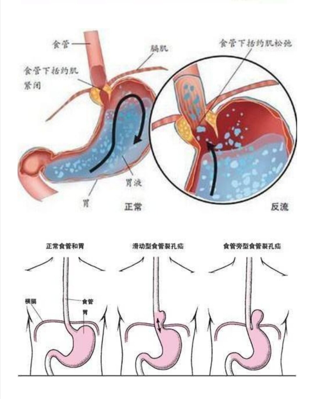 食管裂孔疝是什么病图片