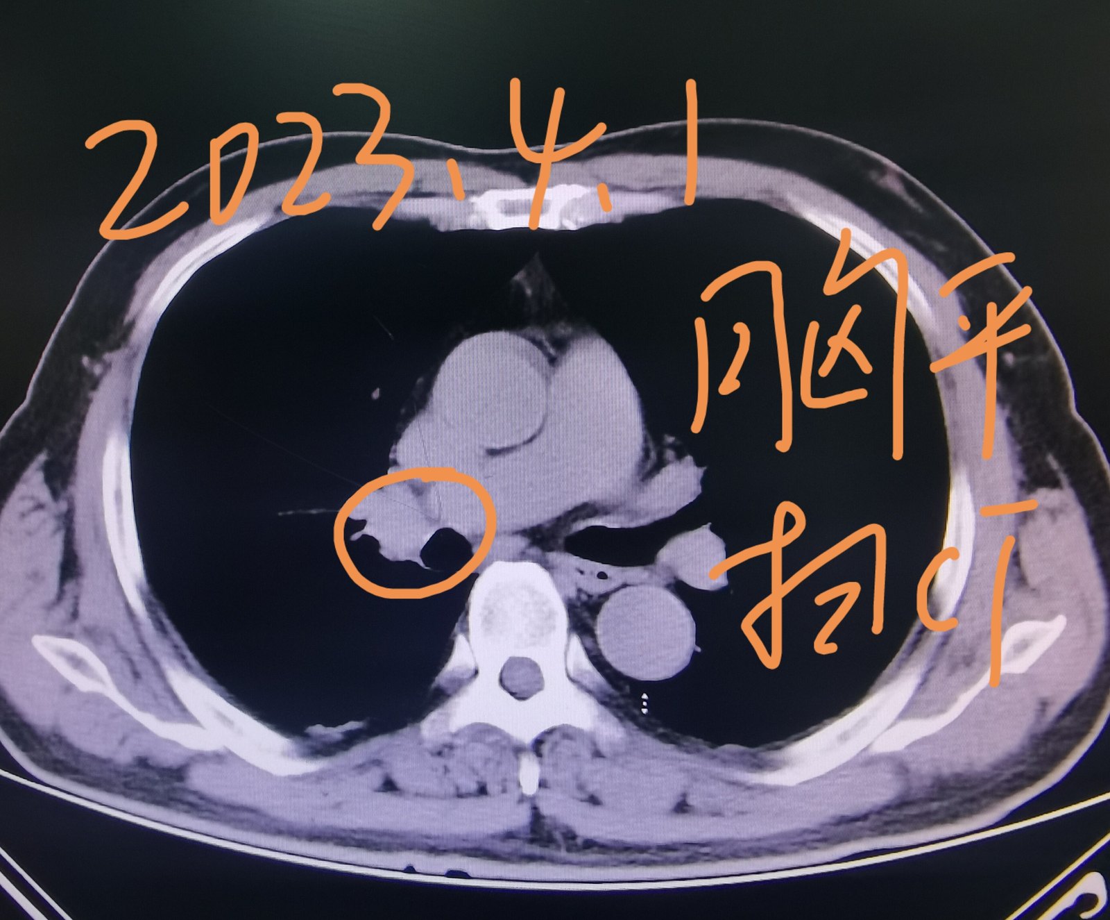 刘懿博士说肺癌（五七〇五）这个肺结节很狡猾，平扫CT都没发现它_肺癌_肺癌检查 - 好大夫在线
