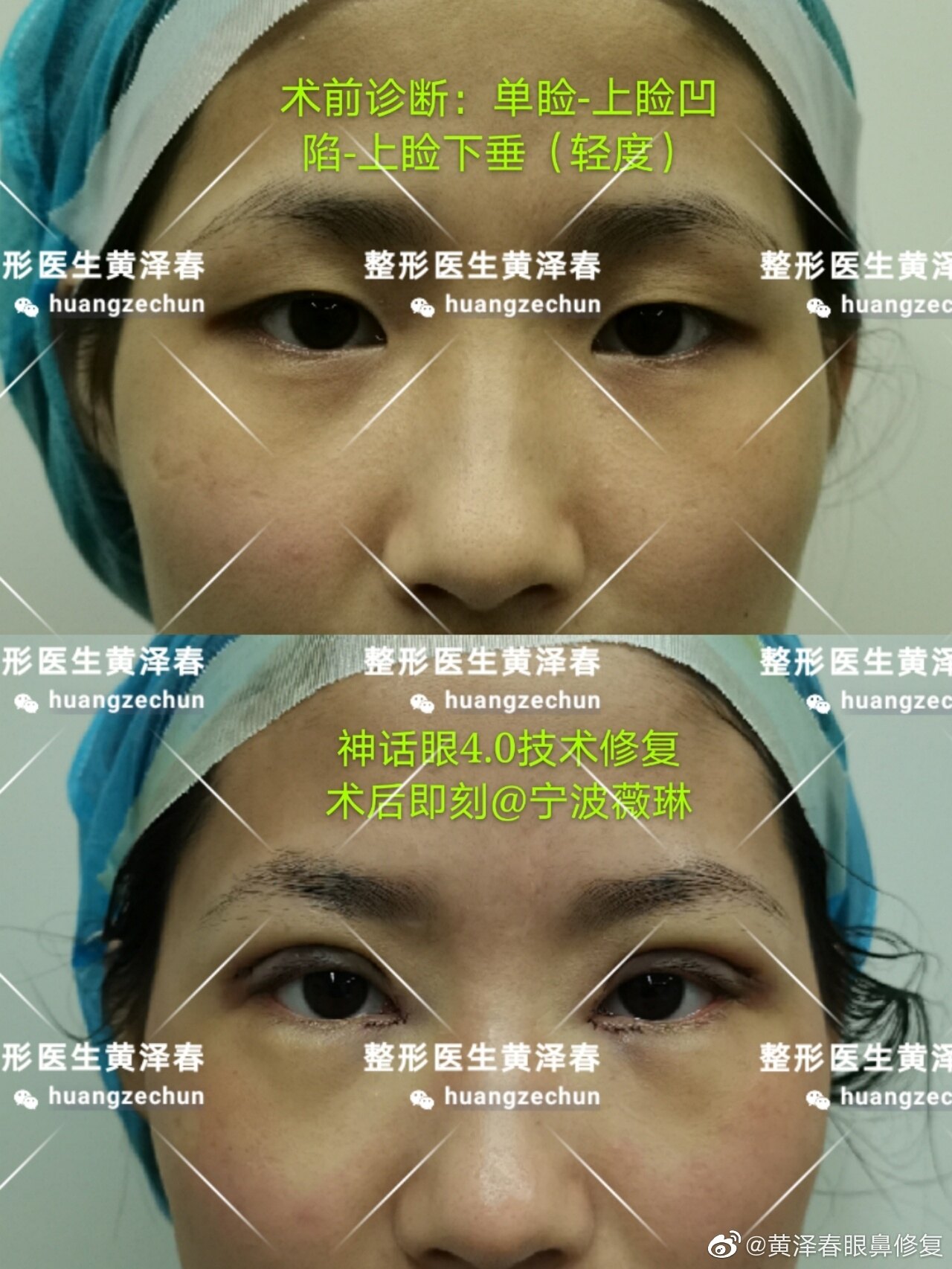 浙一医院 双眼皮手术 全切+抽脂，过程全记录 - 知乎