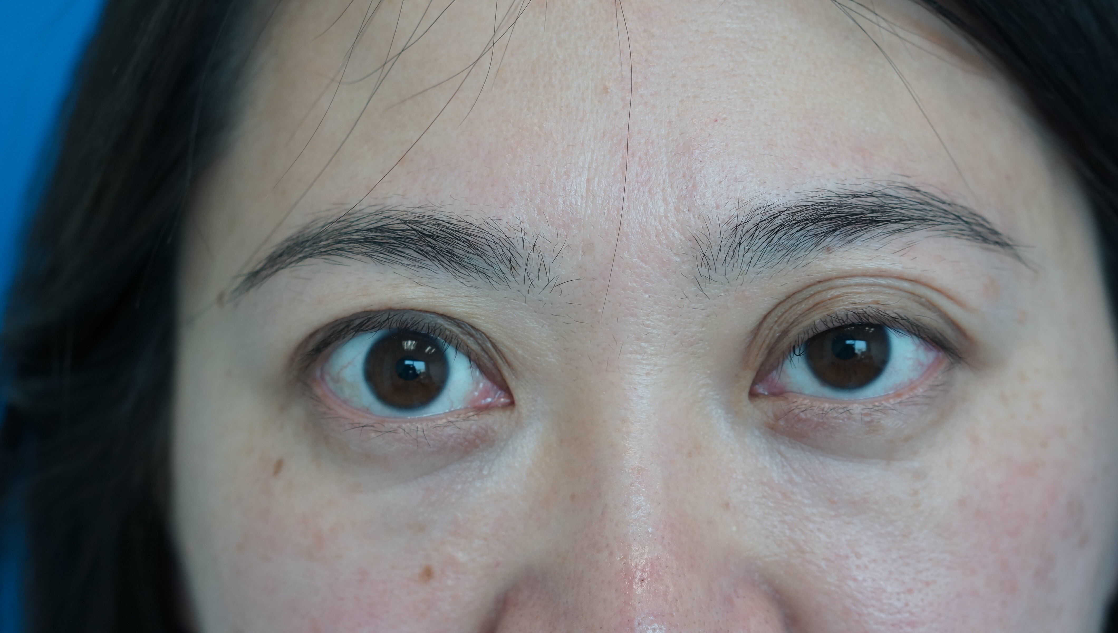 记录上睑下垂+双眼皮手术后恢复过程 - 知乎