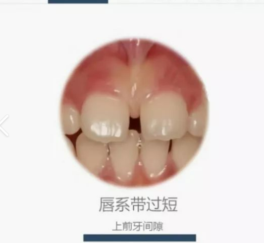 探索上唇系带的“小秘密”,你了解多少?_唇系带异常矫正_唇系带异常矫正治疗介绍 - 好大夫在线