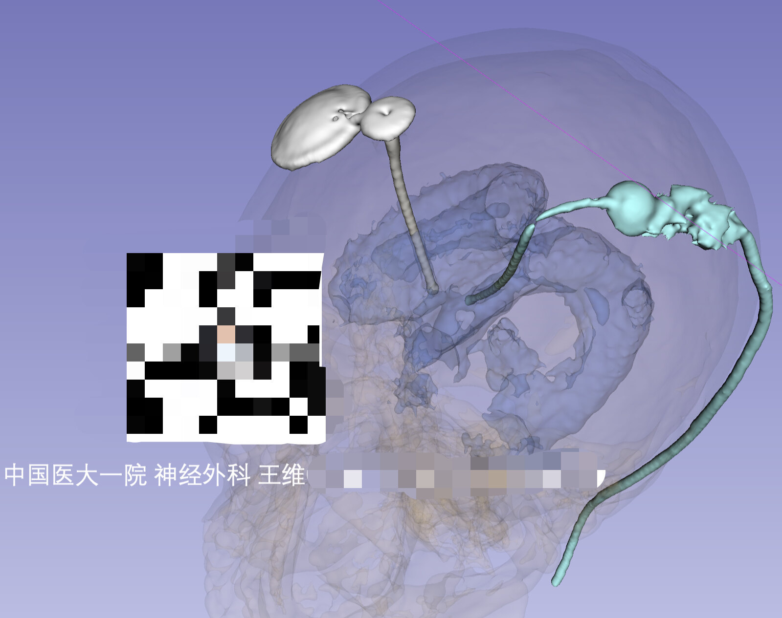 脑膜癌的手术治疗_脑膜瘤_脑膜瘤治疗方式 - 好大夫在线