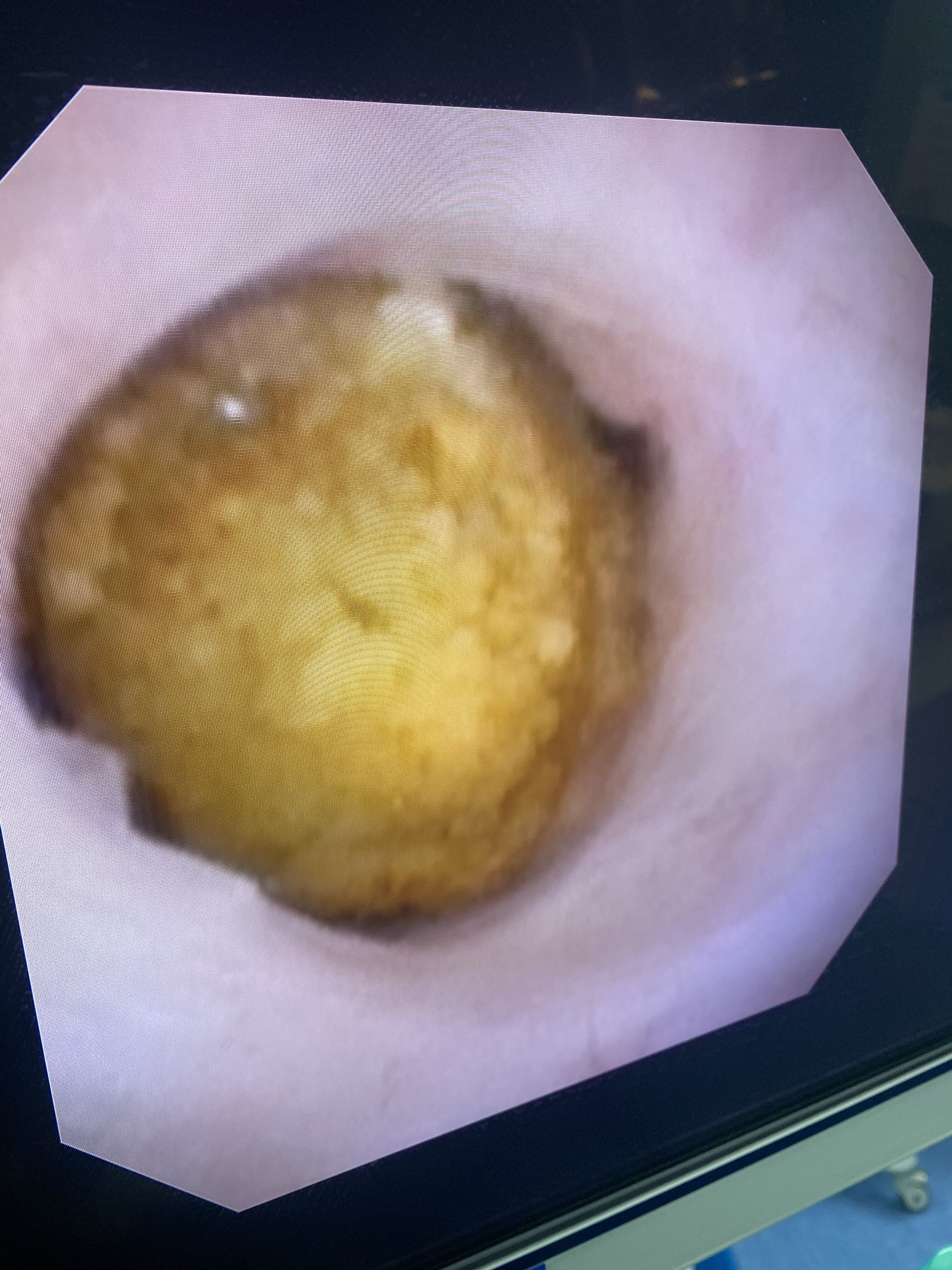 形形色色,千姿百态的泌尿系结石