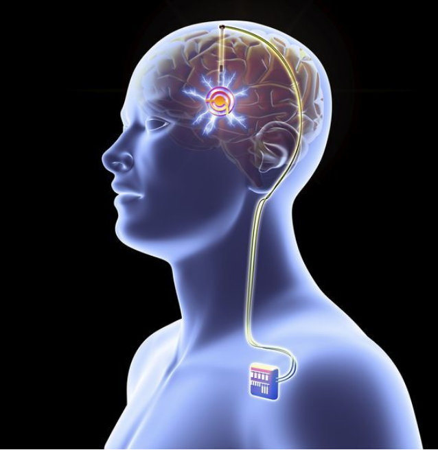 deep-brain-stimulation-artwork-677090921-595450b43df78cdc298a3