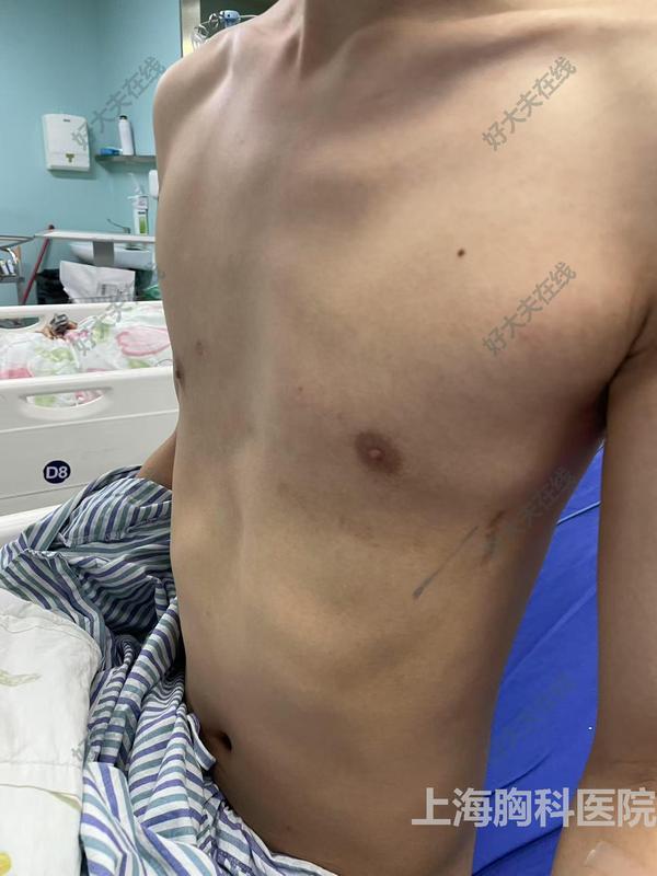 成人复发漏斗胸矫正_漏斗胸- 好大夫在线