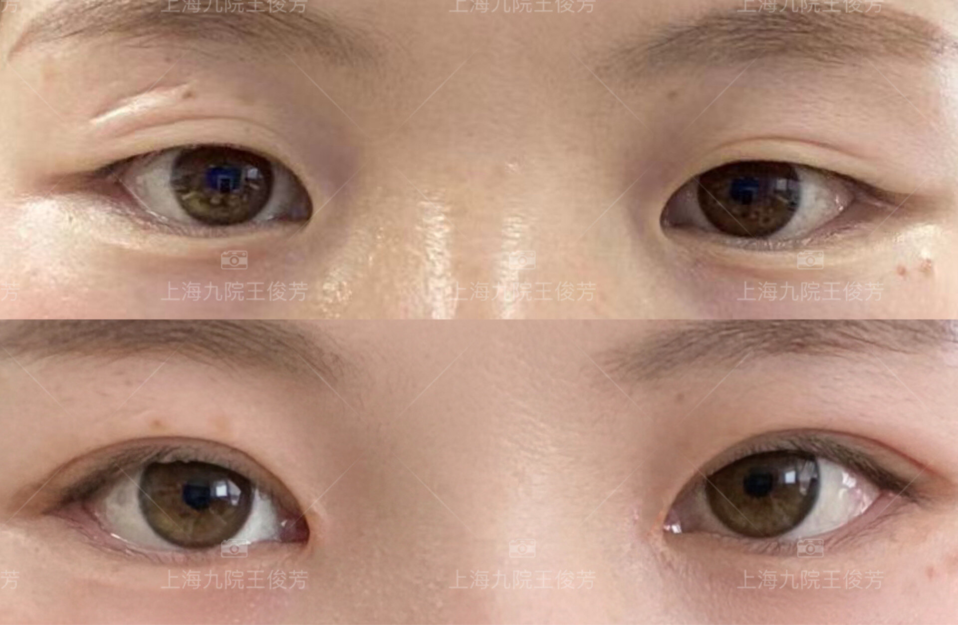眼睑短、圆钝松弛伴有内眦赘皮包裹,术后两个月的变化! - 好大夫在线