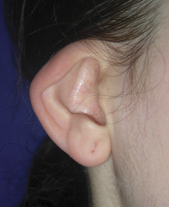 四字箴言读懂"杯状耳"整形手术全攻略(附案例效果多图)