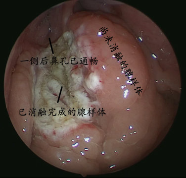 腺样体肥大手术后遗症图片