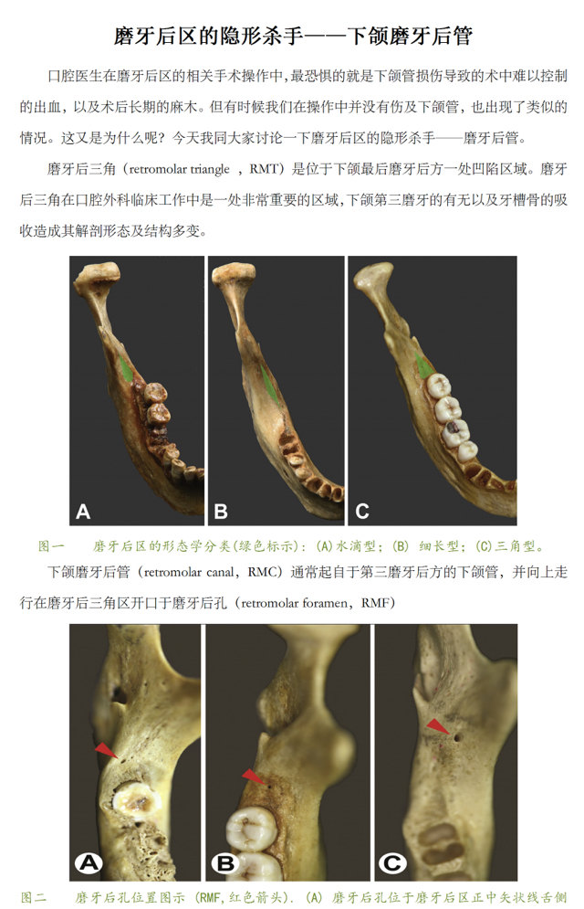 磨牙后区的隐形杀手——下颌磨牙后管 - 好大夫在线