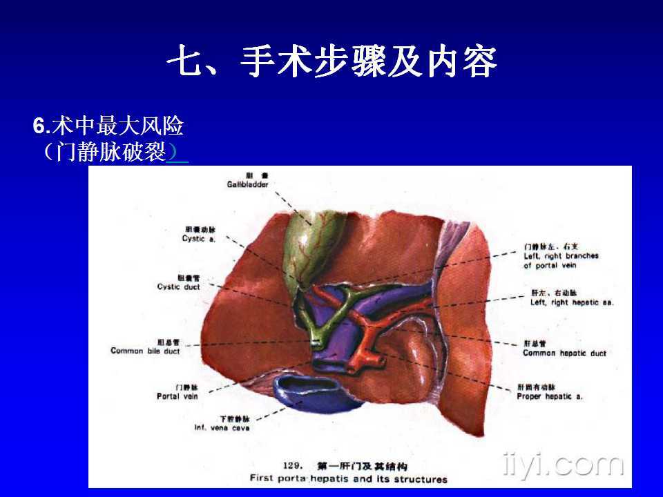 膽總管囊腫手術圖解和術後護理事項圖片版